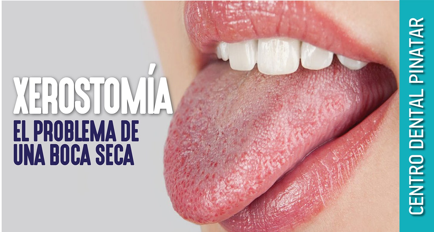 Xerostomia el problema de una boca seca