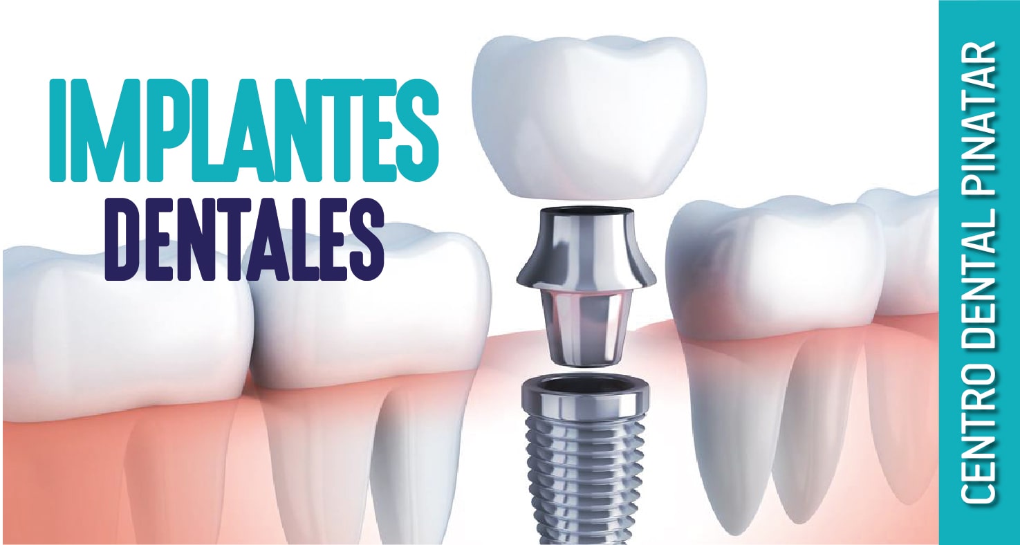 IMPLANTES DENTALES